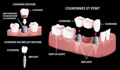 7 couronnes-pont-implants