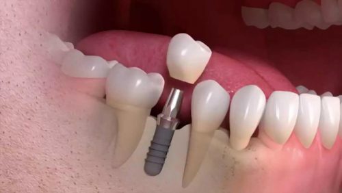 Implant